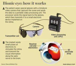 Image Courtesy of Bascom Eye Institute