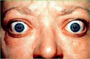 Graves' Disease