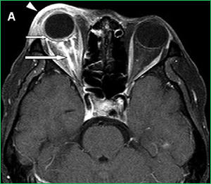 Optic Neuritis MRI