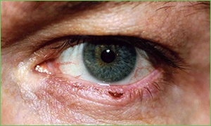 Skin Cancer on the Eyelid